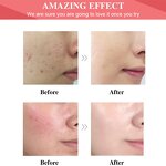 Acne Serum Set - Manufacturer - OEM ODM Glycolic Salicylic Acid Anti Acne Private Label