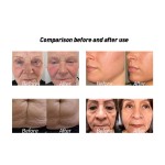 抗衰老RF提升仪工厂-真空滚轮 cavitation