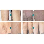 三波长二极管激光供应商-便携式HIFU IPL