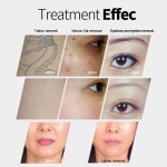 三波长二极管激光供应商-便携式HIFU IPL