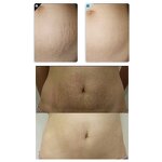 Secret RF Machine - Manufacturer - 10/64/25pin New Design Fractional Microneedle