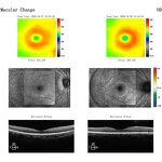 Handheld Slit Lamp - Manufacturer - Ophthalmic Portable Glare Test Equipment