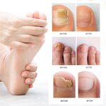 Nail Fungus Removal Cream Manufacturer - Lanthome Onychomycosis Fungal Treatment Paronychia Anti Infection Feet Toe Care