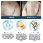 Nail Fungus Removal Cream Manufacturer - Lanthome Onychomycosis Fungal Treatment Paronychia Anti Infection Feet Toe Care