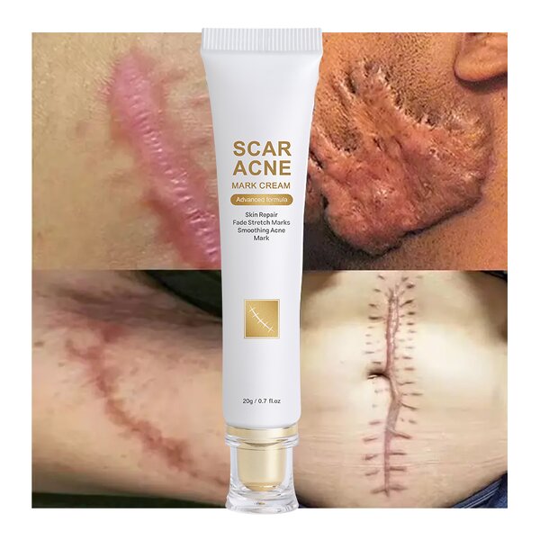 Scar Removal Cream Manufacturer - Acne Stretch Mark Repair - Skin Removing Gel Skincare Products OEM ODM