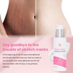 Anti-Stretch Mark Cream Manufacturer - Custom Organic Anti Stretch Mark Wrinkle Beauty Scar Removal Cream