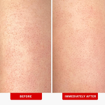 Body Scrub Manufacturer - OEM KP Bump Eraser with 10% AHA for Keratosis Pilaris Exfoliation Glycolic Lactic Acids