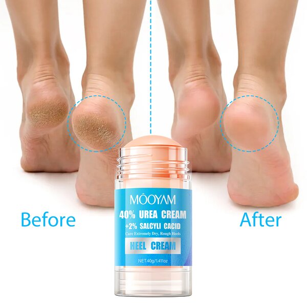 Foot Cream Manufacturer - 40% Urea+2% Salicylic Acid for Dry Rough Skin Nourishing OEM MOOYAM