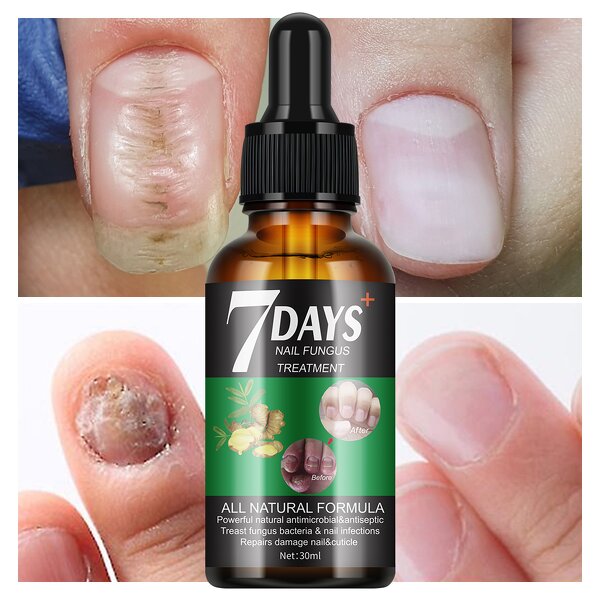 Nail Treatment Serum Manufacturer - 7 Days Nail Fungus for Damage Repair 30ml New Design MOOYAM