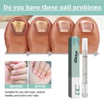 Nail Repair Pen Manufacturer - South Moon Thick Nail Onychomycosis Subungual Edema Fungal Infection Treatment