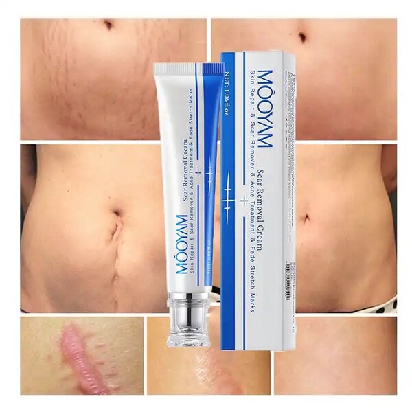 Scar Removal Cream Manufacturer - Fastest Acne Scar Face Care Scar Gel Bruise Repair Tummy Tuck 30g Stretch Mark