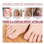 Nail Renewal Liquid Manufacturer - Nail Renewal Extra Strength Fungus Toe Fingernails Repair Damaged Broken 7 Days