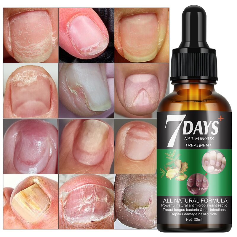 Nail Treatment Serum Manufacturer - 7 Days Remove Onychomycosis Foot Protector Fungal Nail Repairing