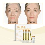 Protein Thread Lifting Set Manufacturer - Facial Sculpting Lift Firming Eye Wrinkle Anti-Wrinkle Serum