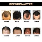 Polygonum Hair Serum Manufacturer - Hot Selling Natural Organic Preventing Hair Loss Treatment Growth