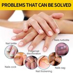 Nail Repair Serum Manufacturer - OEM Manufacturer Wholesale Natural 15ml Anti Bacterial Fungal