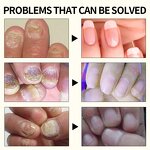 Nail Treatment Serum Manufacturer - Strong Effective 7 Days Nails Fungus Repair Nourishing Damage Natural