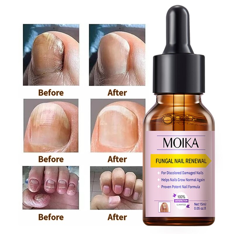 Nail Treatment Serum Manufacturer - Strong Effective 7 Days Nails Fungus Repair Nourishing Damage Natural