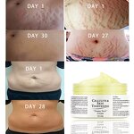 Maternity Cream - Skin Repair Stretch Mark Removal & OEM