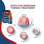 Ingrown Toenail Treatment Manufacturer - Pain Reliever Corrector Patches Removal Kit with File