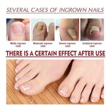 Paronychia Relief Oil Manufacturer - Anti Extra Strength Toenail Fungus Treatment for Damaged
