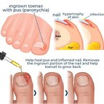 Paronychia Relief Oil Manufacturer - Anti Extra Strength Toenail Fungus Treatment for Damaged