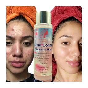 Facial Toner Manufacturer - Branding Customized Eliminate Acne Pimple Pigmentation Correct Skin Revitalizer Lighten
