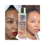 Rose Water Toner Manufacturer - Manufacturer Clear Acne Treat Pimple Refreshes Soothes Whitens Radiant Oil Control