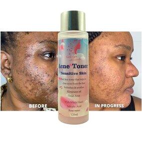 Face Toner Manufacturer - Best Effectively Treat Acne Pimples Moisturize Lightening Repair Soothe Skin