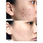 Face Serum Manufacturer - Salicylic Acid Acne Care Pimple Moisturizing Face Serum Organic Skincare Products