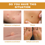 Oral Spray Manufacturer - Bee Venom for Wart Care Soothing Skin Health & Hot Selling