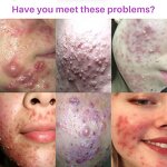 Acne Patches Manufacturer - OEM ODM Medical Grade Acne Treatment Waterproof Transparent Invisible Facial