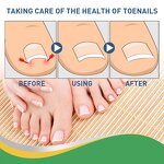 Toenail Patches - OEM Wholesale 50pc Groove Correction Manicure Supplier