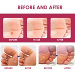Corn Removal Pads - OEM 10 Patches Medical Foot Care Calluses Remover