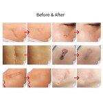 Deep Acne Scar Cream - Manufacturer - Private Label Old Scars Stretch Marks Scar Removal Treatment