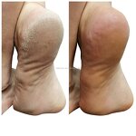 Foot Callus Remover Gel - Manufacturer - OEM ODM Professional Exfoliator Dead Skin Eliminator