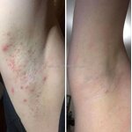 Aftershave Wipes - Manufacturer - Private Label Shaving Waxing Razor Burn Ingrown Hair Treatment