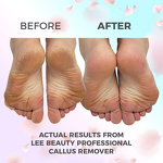 Professional Callus Remover Gel - Manufacturer - Private Label Exfoliating Dead Skin Foot Care