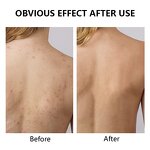 Large Acne Patch - Manufacturer - Private Label Hydrocolloid Face Body Pimple Acne Patches