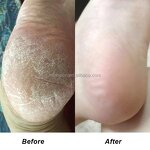 Foot Peeling Spray - Manufacturer - Private Label Dead Skin Removal Orange Oil Moisturizing Hydrating