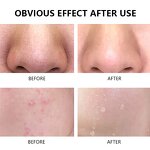 Acne Skin Care Set - Factory - ODM OEM Benzoyl Peroxide Cleanser Toner Serum Whitening