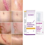 Acne Scar Removal Cream - Manufacturer - EKBER Vegan Private Label Skin Damage Repair Scar Remover Cream