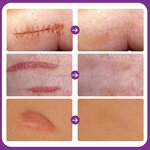 Acne Scar Removal Cream - Manufacturer - EKBER Vegan Private Label Skin Damage Repair Scar Remover Cream