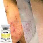 Colloidal Sulfur Serum - Factory - Wholesale Organic Private Label Yeast Pox Clearing Acne Treatment Custom Serum