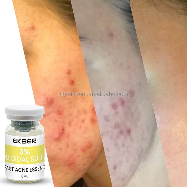Colloidal Sulfur Serum - Factory - Wholesale Organic Private Label Yeast Pox Clearing Acne Treatment Custom Serum