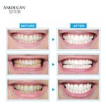 LED Teeth Whitening Light - Factory - Teeth Cleaning Food Grade Blue Light China Factory Wholesale