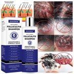 Anti-Fungal Shampoo Manufacturer - Hot Sale for Itchy Dry Scalp & Folliculitis