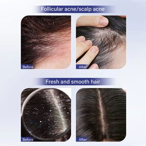 Anti Dandruff Shampoo Manufacturer - New Fashion Anti Tinea Capitis Formula