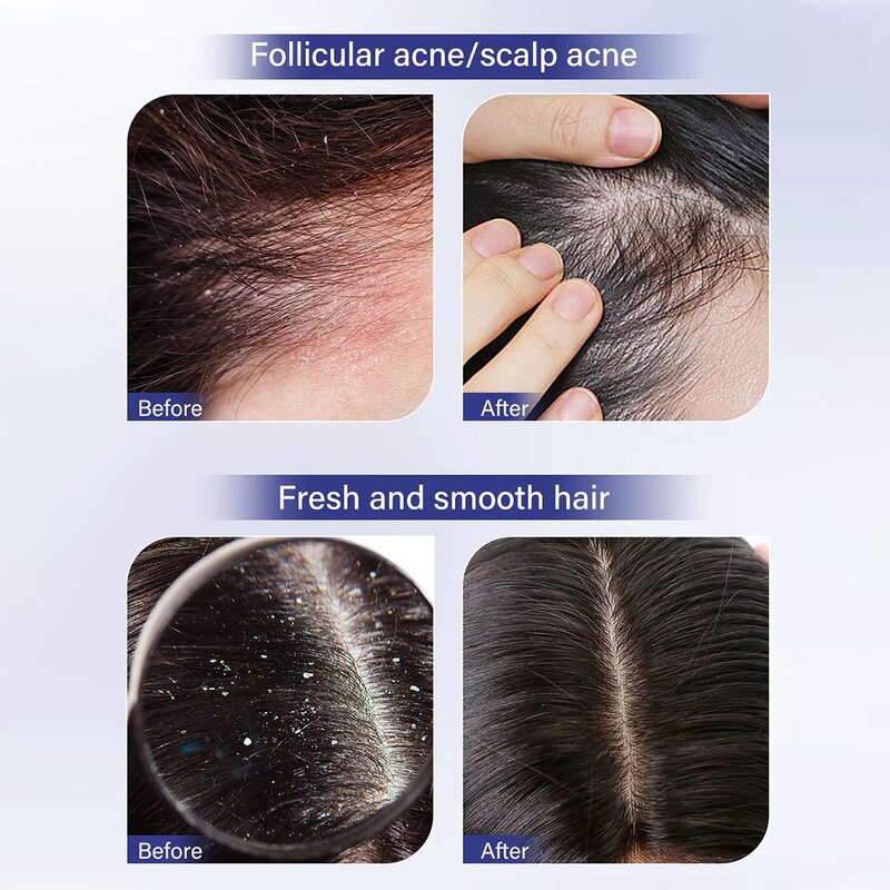 Anti Dandruff Shampoo Manufacturer - New Fashion Anti Tinea Capitis Formula