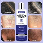 Scalp Psoriasis Shampoo Manufacturer - Spot Product with Tea Tree Oil for Relief